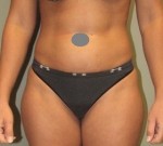 Liposuction