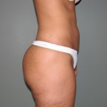 Liposuction