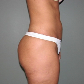 Liposuction