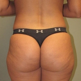 Liposuction