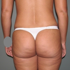 Liposuction