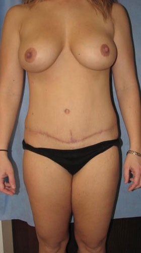 Liposuction