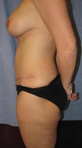 Liposuction