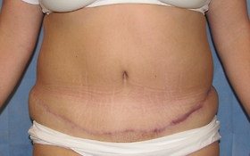 Tummy Tuck