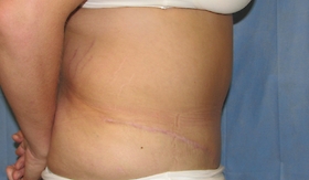 Tummy Tuck