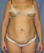 Tummy Tuck