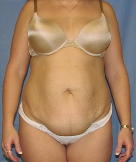 Tummy Tuck