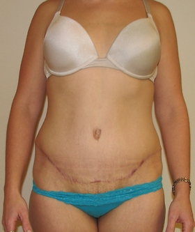 Tummy Tuck