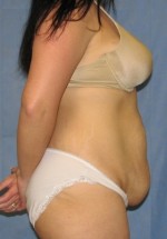 Tummy Tuck