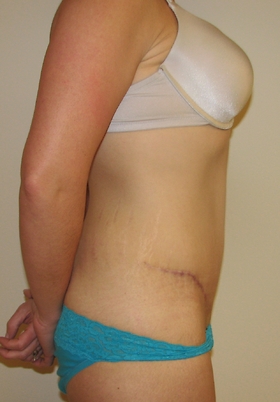 Tummy Tuck