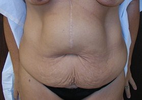 Tummy Tuck