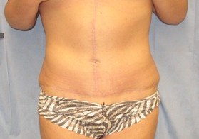 Tummy Tuck