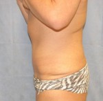 Tummy Tuck