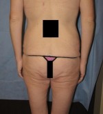 Tummy Tuck