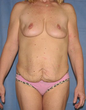 Tummy Tuck