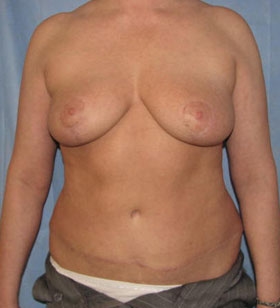 Tummy Tuck