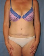 Tummy Tuck