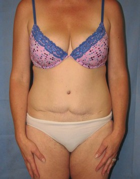 Tummy Tuck