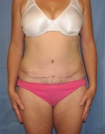 Tummy Tuck