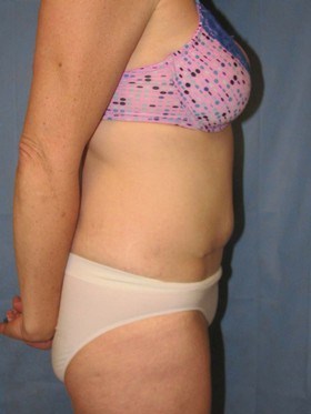 Tummy Tuck