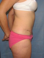 Tummy Tuck