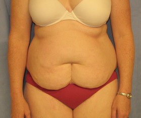 Tummy Tuck