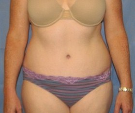 Tummy Tuck