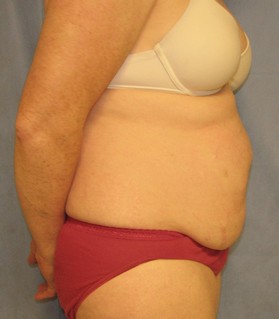 Tummy Tuck