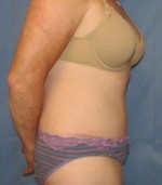 Tummy Tuck