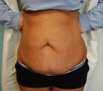 Tummy Tuck