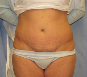 Tummy Tuck