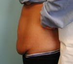 Tummy Tuck