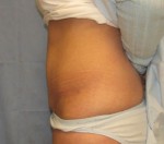 Tummy Tuck