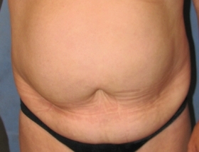 Tummy Tuck Case 2655 Before Photo Tummy Tuck