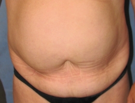 Tummy Tuck