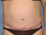 Tummy Tuck