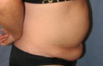 Tummy Tuck