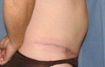 Tummy Tuck