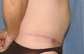 Tummy Tuck Case 2655 After Photo Tummy Tuck