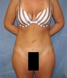 Tummy Tuck