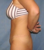 Tummy Tuck