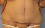 Tummy Tuck