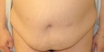 Tummy Tuck