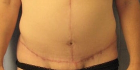 Tummy Tuck