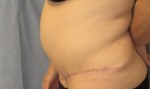 Tummy Tuck