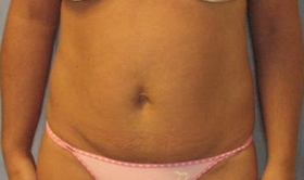 Tummy Tuck