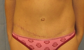 Tummy Tuck