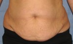 Tummy Tuck