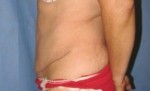 Tummy Tuck