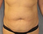 Tummy Tuck